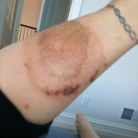 Recluse bite in Detroit?